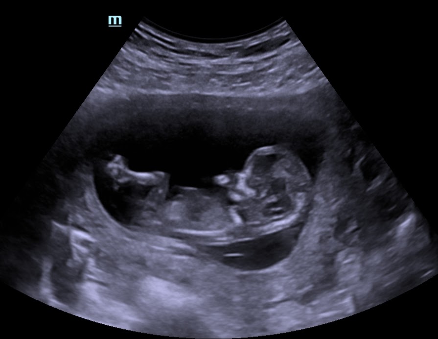 Sneak a Peek Boutique 3D 4D Prenatal Ultrasound Studio Sneak A